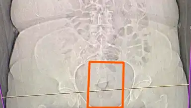 Erzincan'da Midesinde Uyuşturucuyla Yakalanan Şüpheli